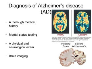 Diagnosis of Alzheimer’s disease
(AD)
• A thorough medical
history
• Mental status testing
• A physical and
neurological exam
• Brain imaging
 