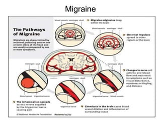 Migraine
 