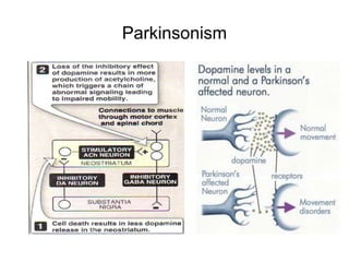 Parkinsonism
 