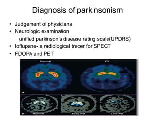 Diagnosis of parkinsonism
• Judgement of physicians
• Neurologic examination
unified parkinson’s disease rating scale(UPDRS)
• Ioflupane- a radiological tracer for SPECT
• FDOPA and PET
 