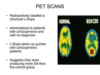 PET SCANS
• Radioactively labelled a
chemical L-Dopa
• administered to patients
with schizophrenia and
with no diagnosis
• L-Dopa taken up quicker
with schizophrenic
patients
• Suggests they were
producing more DA than
the control group
 