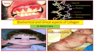 BiochemicalandclinicalaspectsofCollagen
Dr. Rohini C Sane
Epidermolysis bullosa
Scurvy
Ehlers-Danlos syndrome
 