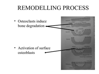 REMODELLING PROCESS
• Osteoclasts induce
bone degradation
• Activation of surface
osteoblasts
 