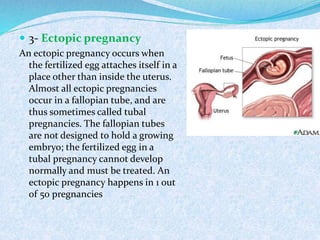  3- Ectopic pregnancy
An ectopic pregnancy occurs when
the fertilized egg attaches itself in a
place other than inside the uterus.
Almost all ectopic pregnancies
occur in a fallopian tube, and are
thus sometimes called tubal
pregnancies. The fallopian tubes
are not designed to hold a growing
embryo; the fertilized egg in a
tubal pregnancy cannot develop
normally and must be treated. An
ectopic pregnancy happens in 1 out
of 50 pregnancies
 