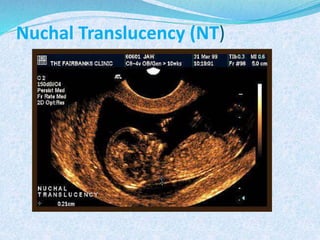 Nuchal Translucency (NT)
 