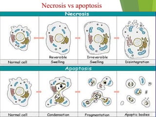 Necrosis vs apoptosis
 