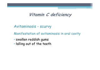 Vitamin C deficiency
Avitaminosis - scurvy
Manifestation of avitaminosis in oral cavity
• swollen reddish gums
• falling out of the teeth
 