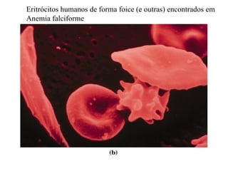 Eritrócitos humanos de forma foice (e outras) encontrados em
Anemia falciforme
 