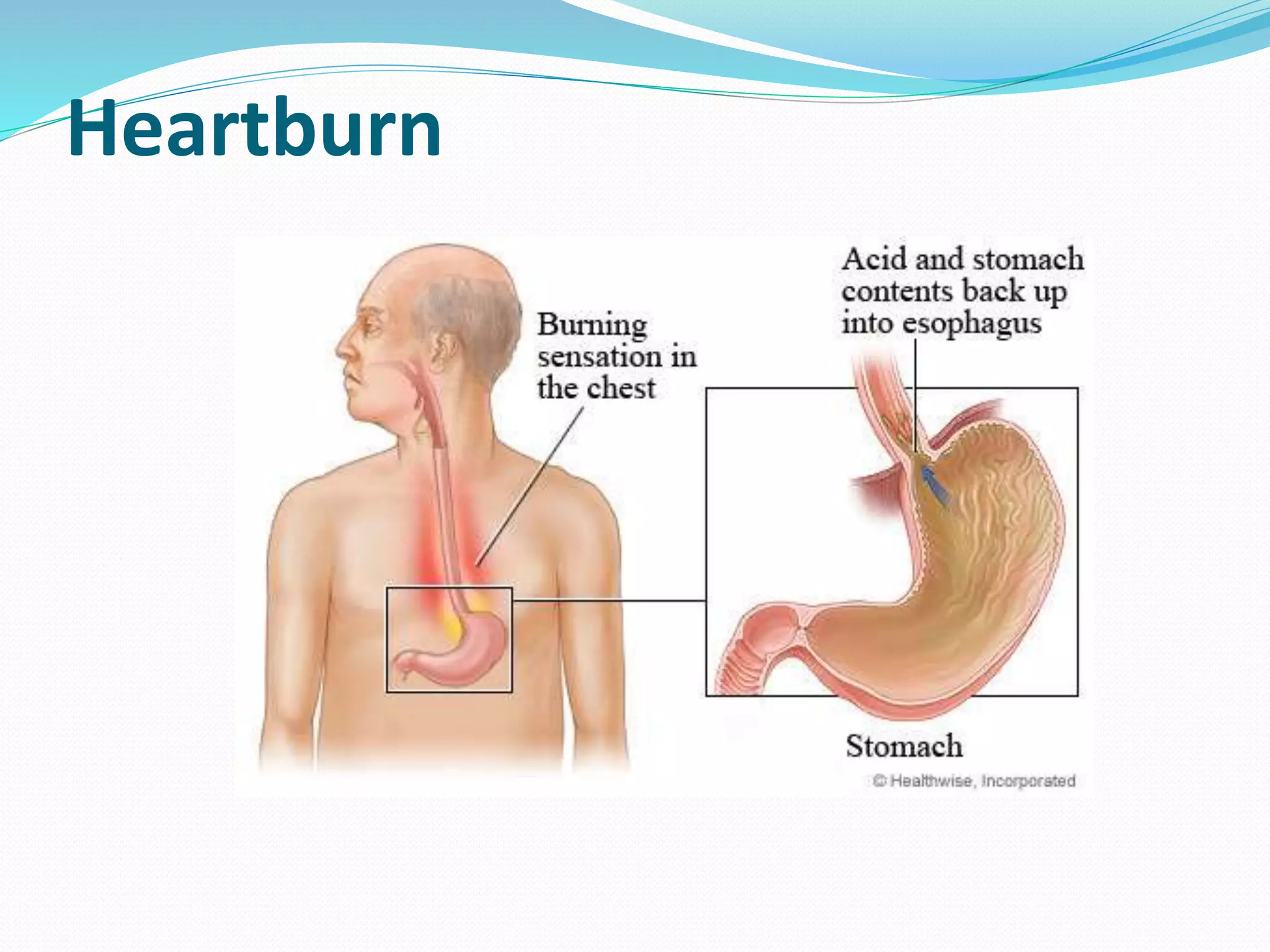 Reflux Inhibitor Is Proton pump inhibitors (PPIs) the best treatment for ...