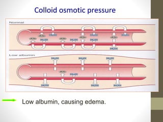 Colloid osmotic pressure
Low albumin, causing edema.
 