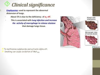 Clinical significance
1. Emphysema: used to represent the abnormal
distension of lungs.
• About 5% is due to the deficiency of α1–AT.
• This is associated with lung infection and increase
the activity of macrophage to release elastase
that damage lungs tissue.
To methionine sulphoxide and activate alpha att.
 Smoking can cause oxidation of Met358
 