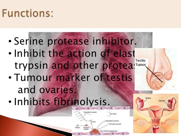 Alpha -1 antitrypsin deficiency