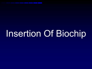 Insertion Of Biochip
 
