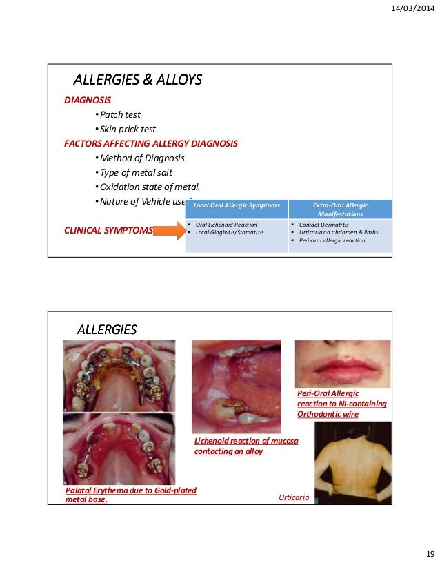 of dental alloys