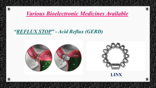 Various Bioelectronic Medicines Available
“REFLUX STOP” - Acid Reflux (GERD)
LINX
 