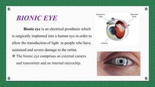 BIONIC EYE
Bionic eye is an electrical prosthesis which
is surgically implanted into a human eye in order to
allow the transduction of light in people who have
sustained and severe damage to the retina.
 The bionic eye comprises an external camera
and transmitter and an internal microchip.
 