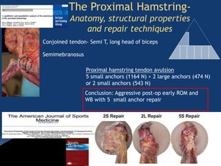 The Proximal Hamstring-
Anatomy, structural properties
and repair techniques
Conjoined tendon- Semi T, long head of biceps
Semimebranosus
Proximal hamstring tendon avulsion
5 small anchors (1164 N) > 2 large anchors (474 N)
or 2 small anchors (543 N)
Conclusion: Aggressive post-op early ROM and
WB with 5 small anchor repair
 