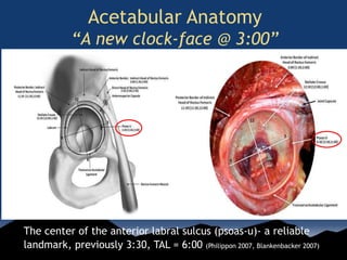 Acetabular Anatomy
“A new clock-face @ 3:00”
The center of the anterior labral sulcus (psoas-u)- a reliable
landmark, previously 3:30, TAL = 6:00 (Philippon 2007, Blankenbacker 2007)
 