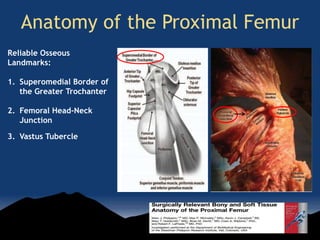 Anatomy of the Proximal Femur
Reliable Osseous
Landmarks:
1. Superomedial Border of
the Greater Trochanter
2. Femoral Head-Neck
Junction
3. Vastus Tubercle
 