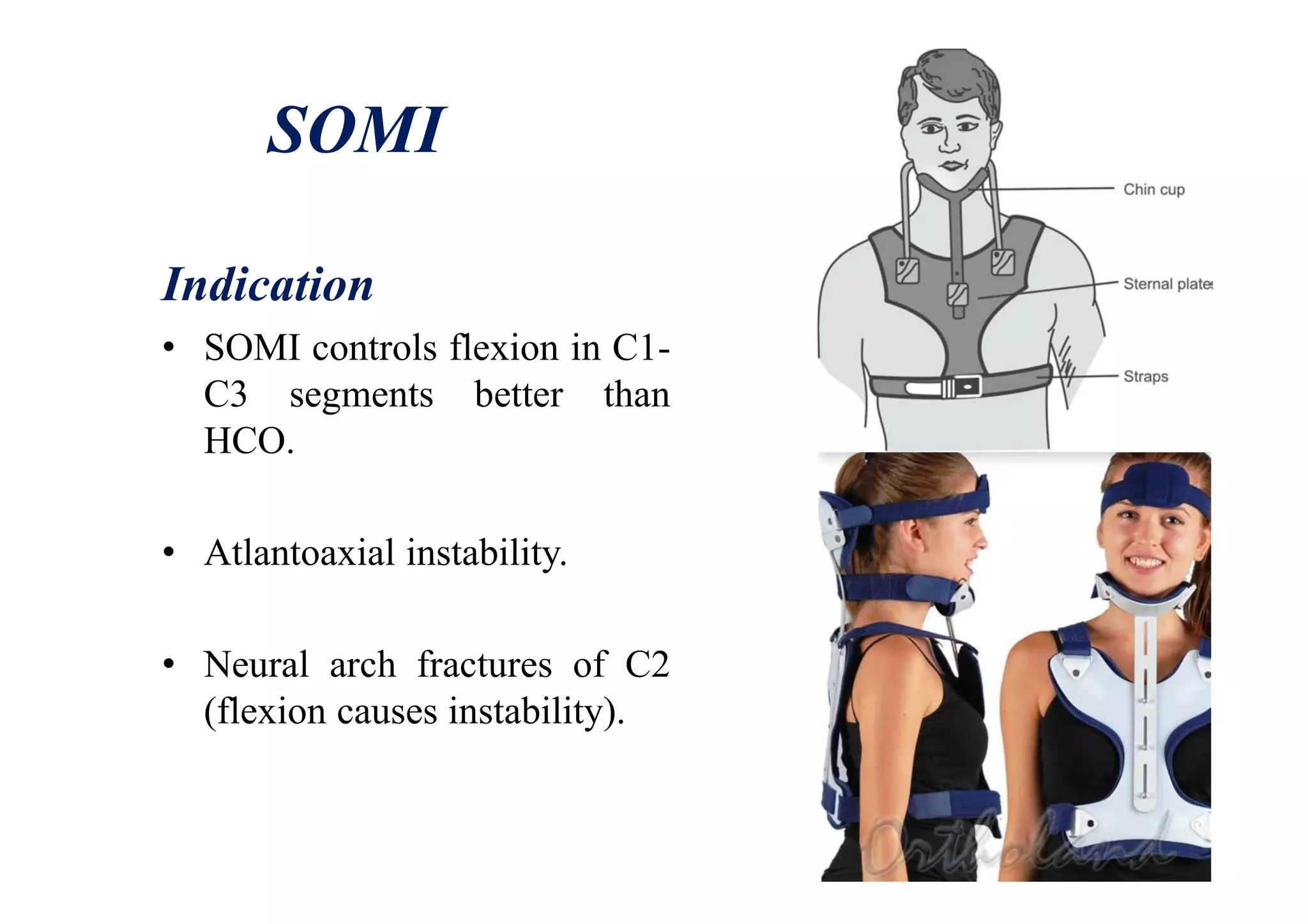 SOMI
Indication
• SOMI controls flexion in C1-
C3 segments better than
HCO.
• Atlantoaxial instability.
• Neural arch fractures of C2
(flexion causes instability).
 