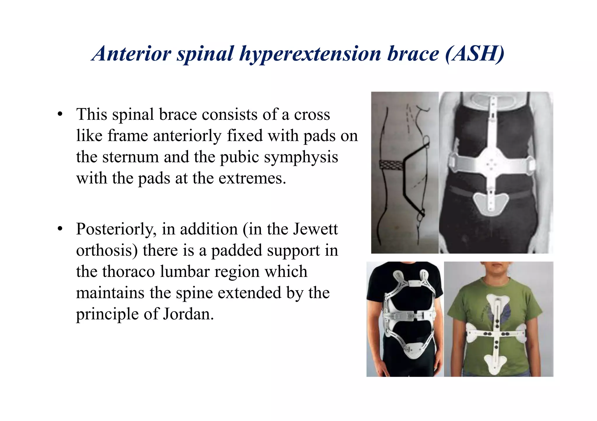 Anterior spinal hyperextension brace (ASH)
• This spinal brace consists of a cross
like frame anteriorly fixed with pads on
the sternum and the pubic symphysis
with the pads at the extremes.
• Posteriorly, in addition (in the Jewett
orthosis) there is a padded support in
the thoraco lumbar region which
maintains the spine extended by the
principle of Jordan.
 
