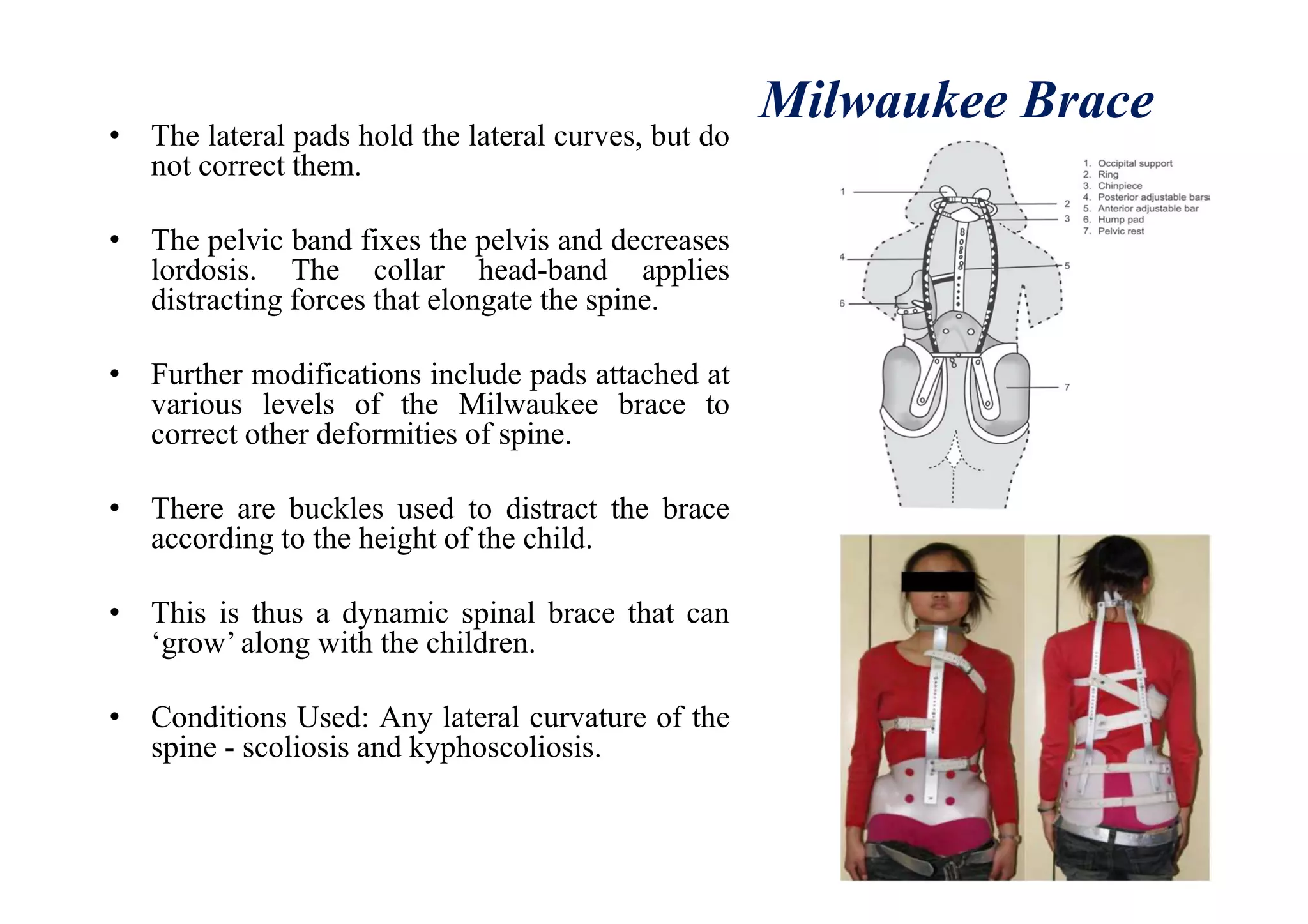 Milwaukee Brace
• The lateral pads hold the lateral curves, but do
not correct them.
• The pelvic band fixes the pelvis and decreases
lordosis. The collar head-band applies
distracting forces that elongate the spine.
• Further modifications include pads attached at
various levels of the Milwaukee brace to
correct other deformities of spine.
• There are buckles used to distract the brace
according to the height of the child.
• This is thus a dynamic spinal brace that can
‘grow’ along with the children.
• Conditions Used: Any lateral curvature of the
spine - scoliosis and kyphoscoliosis.
 