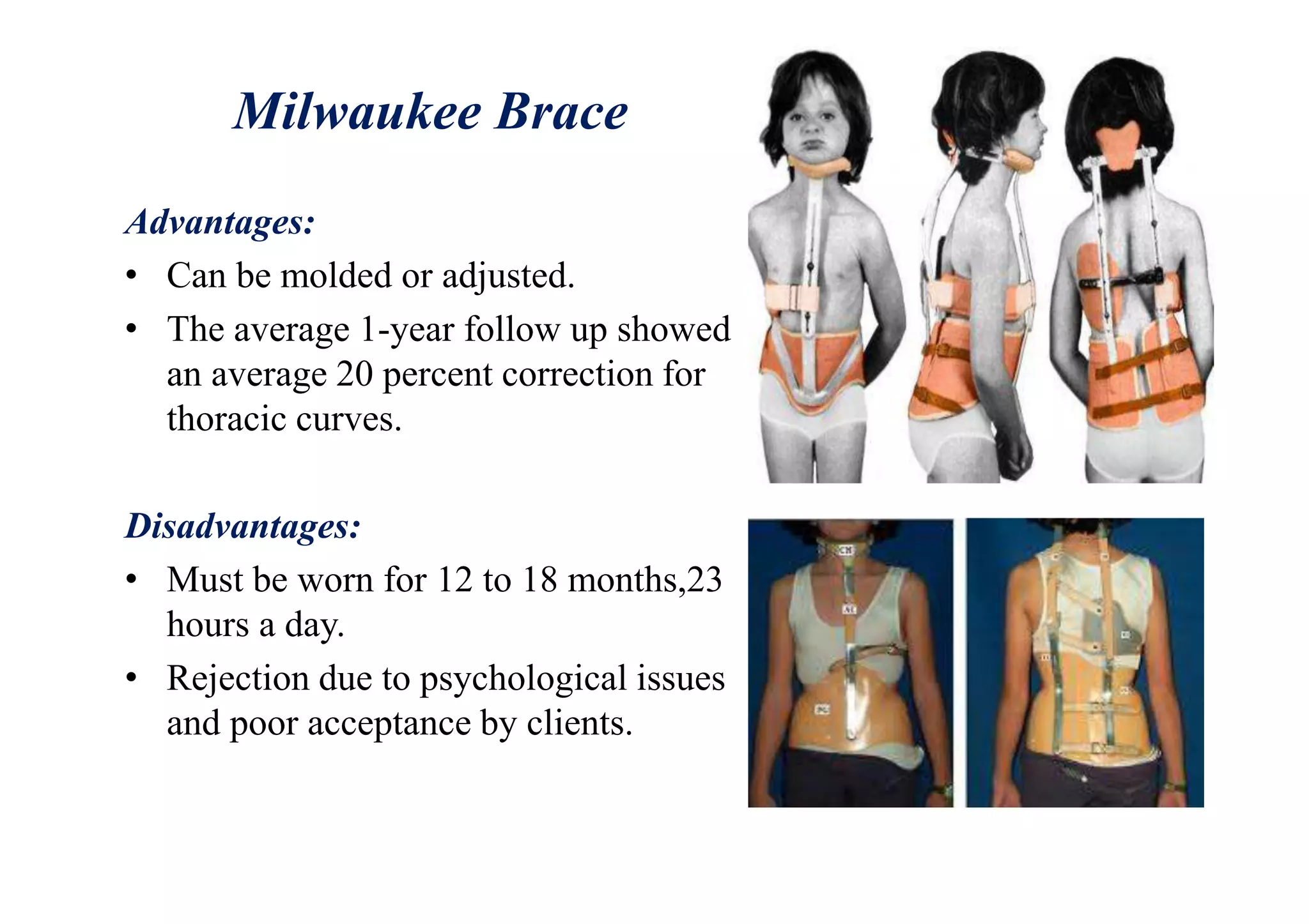 Milwaukee Brace
Advantages:
• Can be molded or adjusted.
• The average 1-year follow up showed
an average 20 percent correction for
thoracic curves.
Disadvantages:
• Must be worn for 12 to 18 months,23
hours a day.
• Rejection due to psychological issues
and poor acceptance by clients.
 