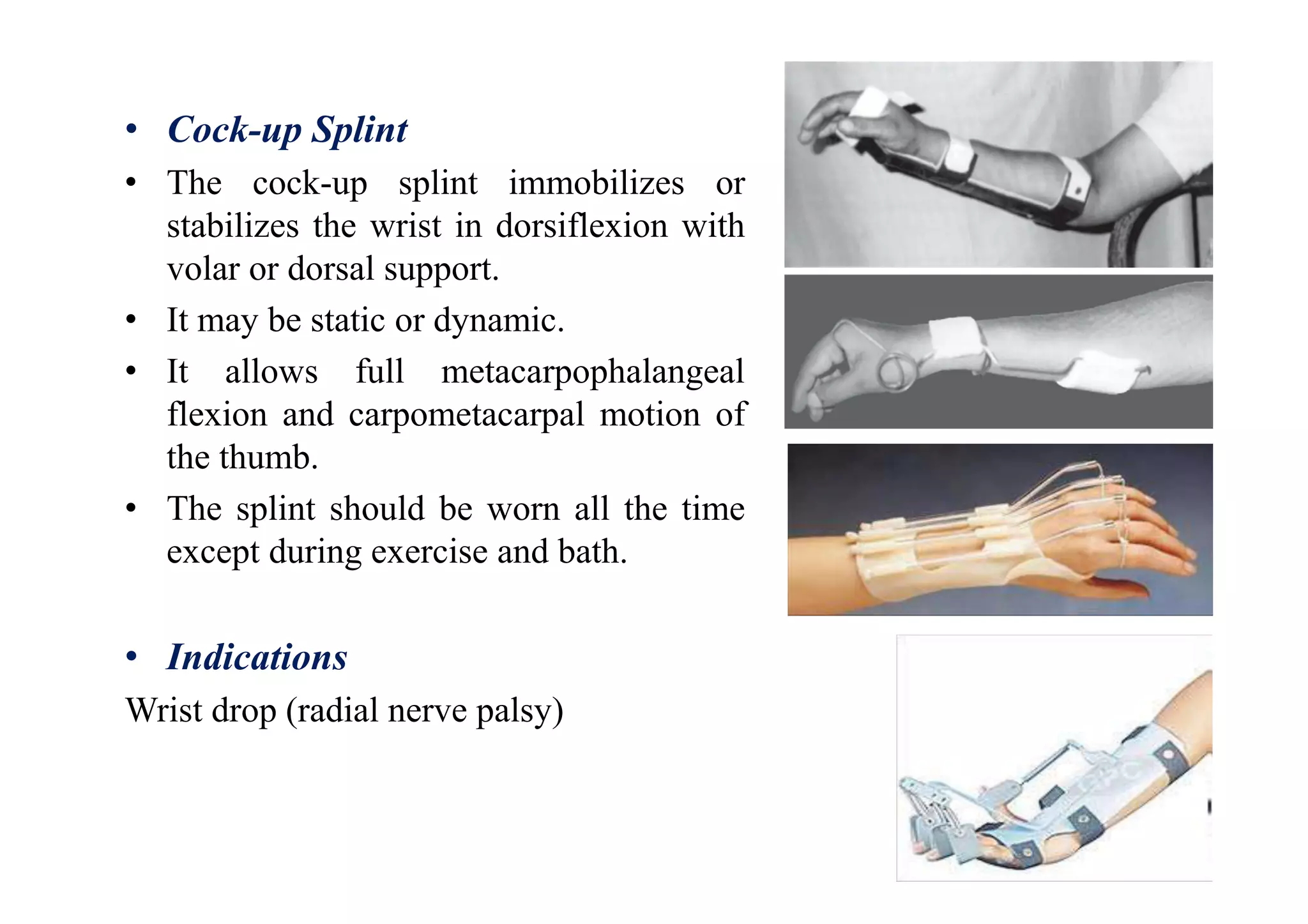 • Cock-up Splint
• The cock-up splint immobilizes or
stabilizes the wrist in dorsiflexion with
volar or dorsal support.
• It may be static or dynamic.
• It allows full metacarpophalangeal
flexion and carpometacarpal motion of
the thumb.
• The splint should be worn all the time
except during exercise and bath.
• Indications
Wrist drop (radial nerve palsy)
 