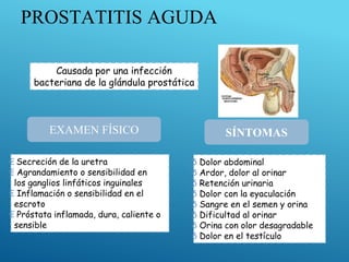 EXAMEN FÍSICO SÍNTOMAS
Causada por una infección
bacteriana de la glándula prostática
δ Dolor abdominal
δ Ardor, dolor al orinar
δ Retención urinaria
δ Dolor con la eyaculación
δ Sangre en el semen y orina
δ Dificultad al orinar
δ Orina con olor desagradable
δ Dolor en el testículo
€ Secreción de la uretra
€ Agrandamiento o sensibilidad en
los ganglios linfáticos inguinales
€ Inflamación o sensibilidad en el
escroto
€ Próstata inflamada, dura, caliente o
sensible
PROSTATITIS AGUDA
 