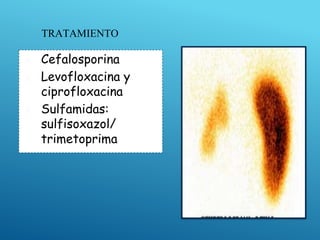 TRATAMIENTO
▣ Cefalosporina
▣ Levofloxacina y
ciprofloxacina
▣ Sulfamidas:
sulfisoxazol/
trimetoprima
 