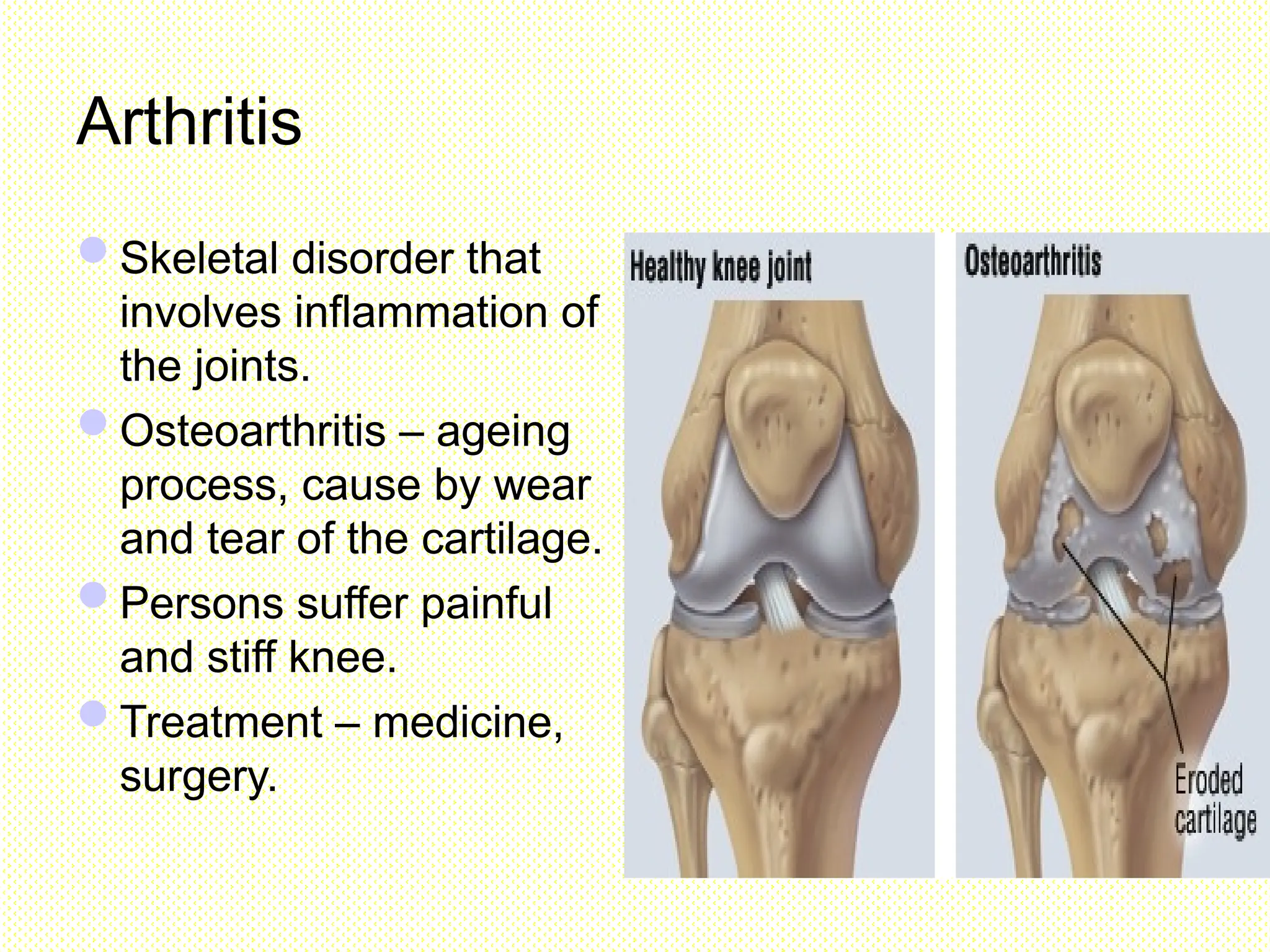 Arthritis
Skeletal disorder that
involves inflammation of
the joints.
Osteoarthritis – ageing
process, cause by wear
and tear of the cartilage.
Persons suffer painful
and stiff knee.
Treatment – medicine,
surgery.
 