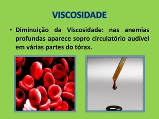 • Diminuição da Viscosidade: nas anemias 
profundas aparece sopro circulatório audível 
em várias partes do tórax. 
 