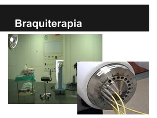 Braquiterapia
 