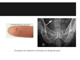 Exemplos de implantes utilizados na Braquiterapia
 