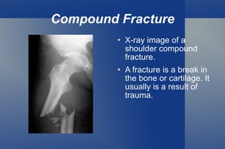 Compound Fracture X-ray image of a shoulder compound fracture. A fracture is a break in the bone or cartilage. It usually is a result of trauma. 