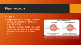 Hipermetropia
• O que é?
• A Hipermetropia é um erro refrativo
em que as imagens são formadas
atrás da retina.
• O doente vê mal ao perto e ao longe
e para que as imagens sejam nítidas,
este efetua um grande esforço
ocular.
 