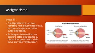Astigmatismo
O que é?
• O astigmatismo é um erro
refrativo num determinado eixo,
em que a imagem na retina
surge desfocada.
• As imagens transmitidas ao
cérebro estão desfocadas ou
distorcidas provocando visão
turva ou visão “embaçada”.
 