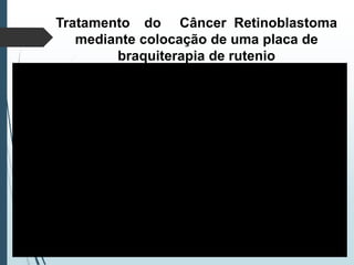 Tratamento do Câncer Retinoblastoma
mediante colocação de uma placa de
braquiterapia de rutenio
 