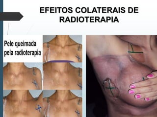 EFEITOS COLATERAIS DE
RADIOTERAPIA
 