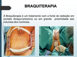 BRAQUITERAPIA
A Braquiterapia é um tratamento com a fonte de radiação em
contato (braqui=próximo) ou em grande proximidade aos
volumes-alvo tumorais.
 