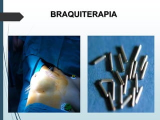 BRAQUITERAPIA
 