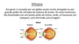 Miopia
Em geral, é causada por um globo ocular muito alongado ou por
grande poder de refração de sistema de lentes. Os raios luminosos
são focalizados em um ponto antes da retina, onde, se houvesse um
anteparo, seria formada uma imagem.
 