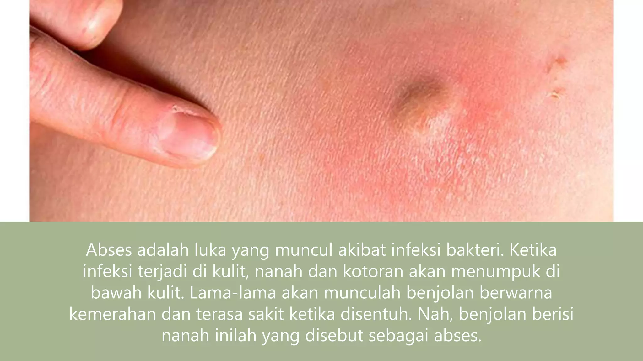 Bioglass untuk abses | PPTX