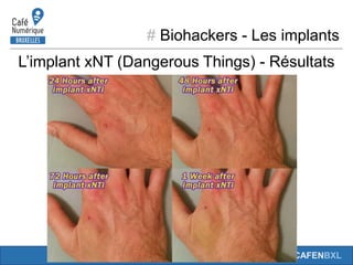 # Biohackers - Les implants
#CAFENBXL
L’implant xNT (Dangerous Things) - Résultats
 