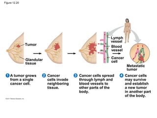 Figure 12.20

Tumor

Lymph
vessel
Blood
vessel

Glandular
tissue

Cancer
cell

1 A tumor grows

from a single
cancer cell.

Metastatic
tumor
2 Cancer

cells invade
neighboring
tissue.

3 Cancer cells spread

through lymph and
blood vessels to
other parts of the
body.

4 Cancer cells

may survive
and establish
a new tumor
in another part
of the body.

 