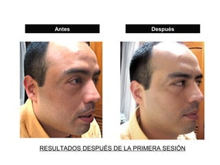 Antes                    Después




RESULTADOS DESPUÉS DE LA PRIMERA SESIÓN
 