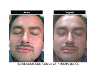 Antes                    Después




RESULTADOS DESPUÉS DE LA PRIMERA SESIÓN
 