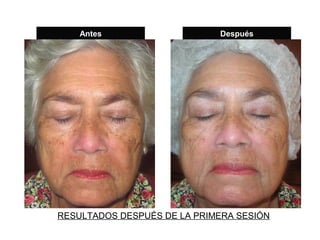 Antes                    Después




RESULTADOS DESPUÉS DE LA PRIMERA SESIÓN
 