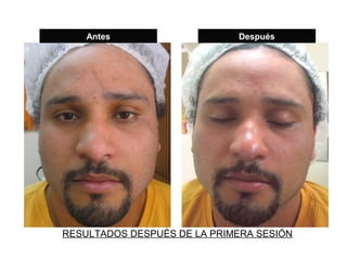 Antes                    Después




RESULTADOS DESPUÉS DE LA PRIMERA SESIÓN
 