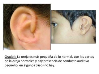 Grado I: La oreja es más pequeña de lo normal, con las partes
de la oreja normales y hay presencia de conducto auditivo
pequeño, en algunos casos no hay.
 